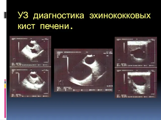 УЗ диагностика эхинококковых кист печени.