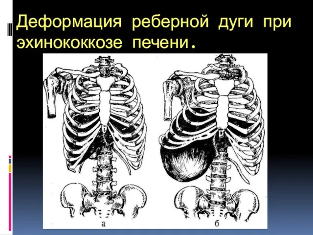 Деформация реберной дуги при эхинококкозе печени.