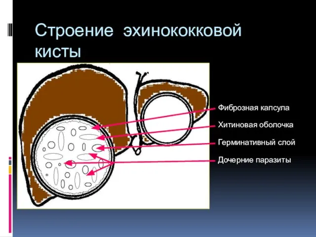 Строение эхинококковой кисты Фиброзная капсула Хитиновая оболочка Герминативный слой Дочерние паразиты