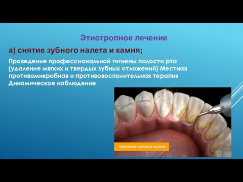Этиотропное лечение а) снятие зубного налета и камня; Проведение профессиональной гигиены полости