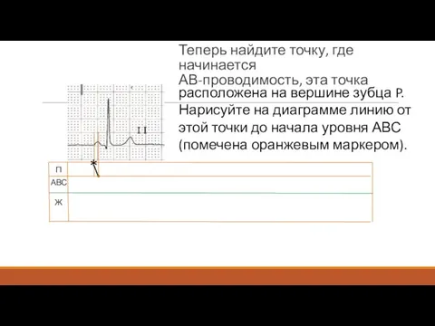 Теперь найдите точку, где начинается АВ-проводимость, эта точка П АВС Ж *