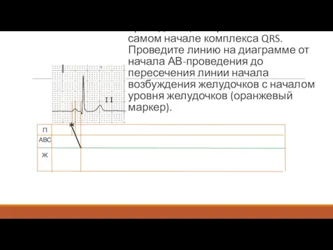 Теперь найдите точку окончания АВ-проведения, она расположена в самом начале комплекса QRS.