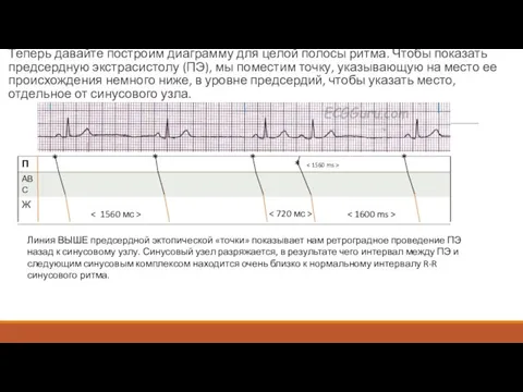 Теперь давайте построим диаграмму для целой полосы ритма. Чтобы показать предсердную экстрасистолу