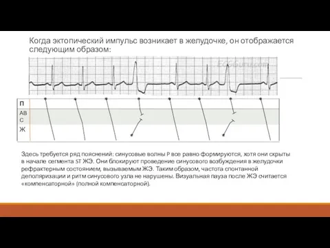 Когда эктопический импульс возникает в желудочке, он отображается следующим образом: * *