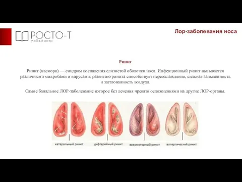 Лор-заболевания носа Ринит Ринит (насморк) — синдром воспаления слизистой оболочки носа. Инфекционный