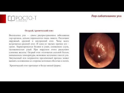 Лор-заболевания уха Острый, хронический отит Воспаление уха — самое распространенное заболевание лор-органов,