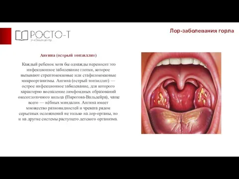 Лор-заболевания горла Ангина (острый тонзиллит) Каждый ребенок хотя бы однажды переносит это