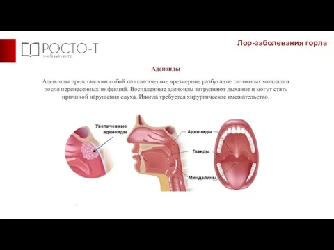 Лор-заболевания горла Аденоиды Аденоиды представляют собой патологическое чрезмерное разбухание глоточных миндалин после
