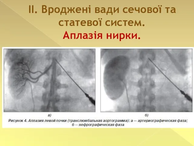 II. Вроджені вади сечової та статевої систем. Аплазія нирки.