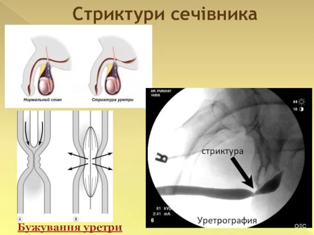 Стриктури сечівника Бужування уретри