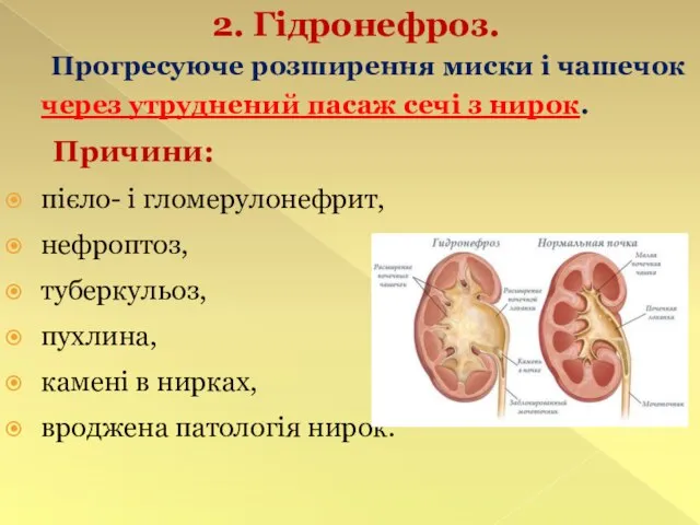 2. Гідронефроз. Прогресуюче розширення миски і чашечок через утруднений пасаж сечі з