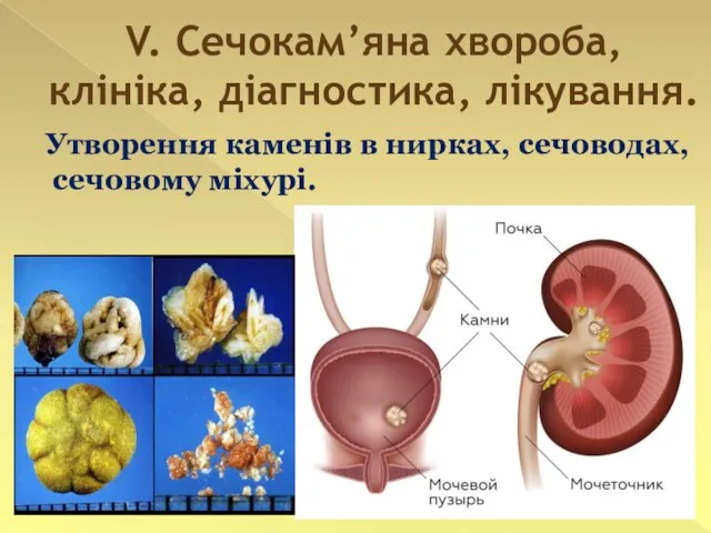 V. Сечокам’яна хвороба, клініка, діагностика, лікування. Утворення каменів в нирках, сечоводах, сечовому міхурі.