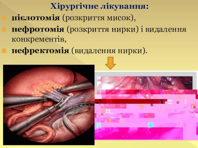 Хірургічне лікування: пієлотомія (розкриття мисок), нефротомія (розкриття нирки) і видалення конкрементів, нефректомія (видалення нирки).