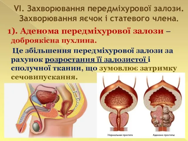 VI. Захворювання передміхурової залози. Захворювання яєчок і статевого члена. 1). Аденома передміхурової