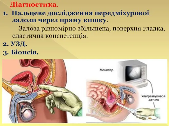 Діагностика. 1. Пальцеве дослідження передміхурової залози через пряму кишку. Залоза рівномірно збільшена,