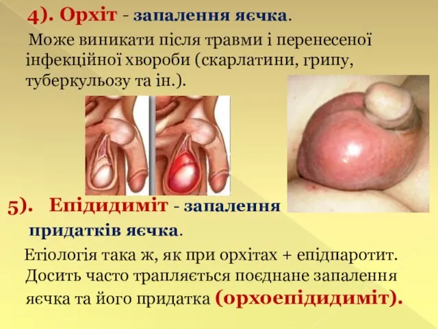 4). Орхіт - запалення яєчка. Може виникати після травми і перенесеної інфекційної