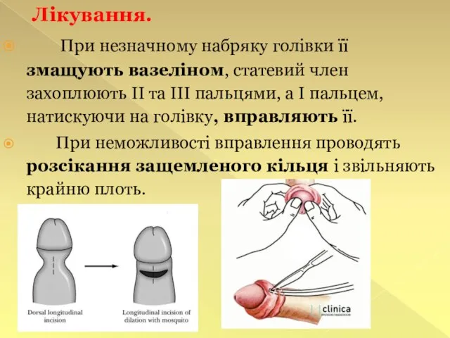 Лікування. При незначному набряку голівки її змащують вазеліном, статевий член захоплюють II