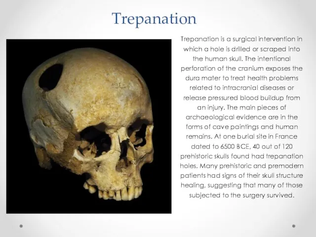Trepanation Trepanation is a surgical intervention in which a hole is drilled