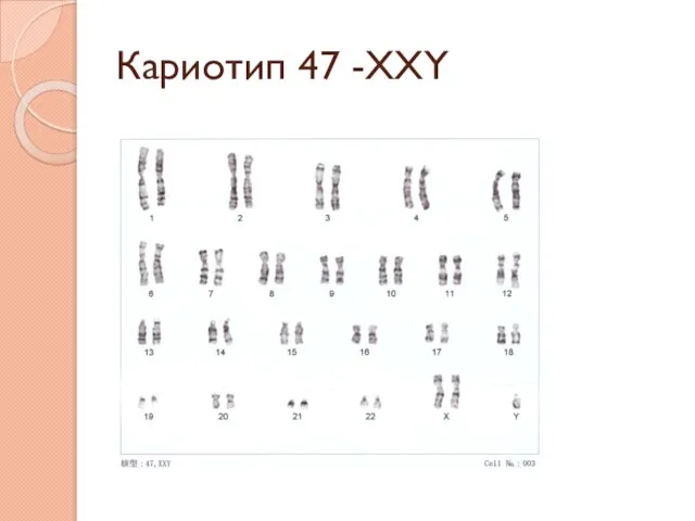 Кариотип 47 -XXY