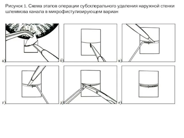 Рисунок 1. Схема этапов операции субсклерального удаления наружной стенки шлеммова канала в микрофистулизирующем вариан