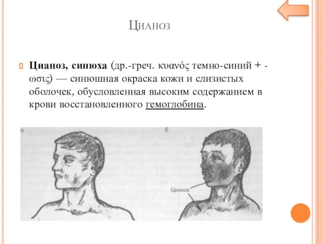 Цианоз Цианоз, синюха (др.-греч. κυανός темно-синий + -ωσις) — синюшная окраска кожи