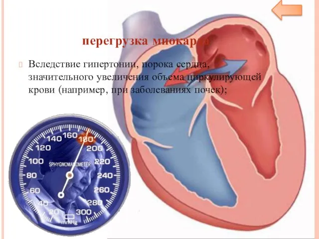 перегрузка миокарда Вследствие гипертонии, порока сердца, значительного увеличения объема циркулирующей крови (например, при заболеваниях почек);