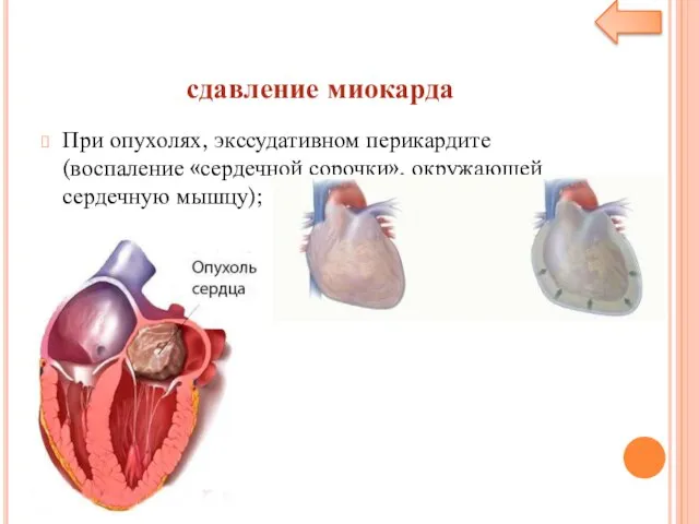 сдавление миокарда При опухолях, экссудативном перикардите (воспаление «сердечной сорочки», окружающей сердечную мышцу);