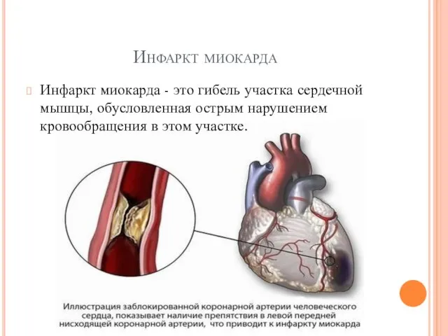 Инфаркт миокарда Инфаркт миокарда - это гибель участка сердечной мышцы, обусловленная острым