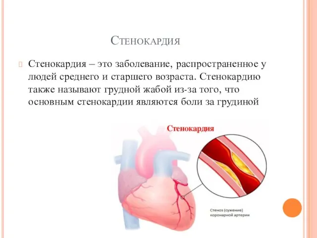 Стенокардия Стенокардия – это заболевание, распространенное у людей среднего и старшего возраста.