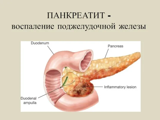 ПАНКРЕАТИТ - воспаление поджелудочной железы