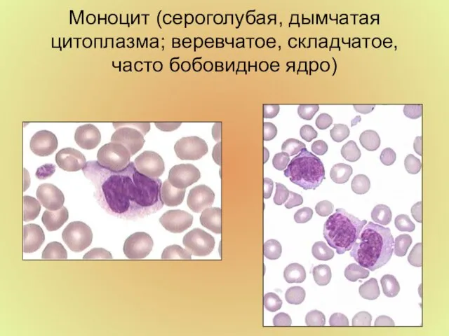 Моноцит (сероголубая, дымчатая цитоплазма; веревчатое, складчатое, часто бобовидное ядро)