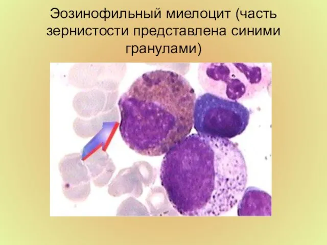 Эозинофильный миелоцит (часть зернистости представлена синими гранулами)