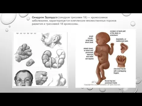 Синдром Э́двардса (синдром трисомии 18) — хромосомное заболевание, характеризуется комплексом множественных пороков