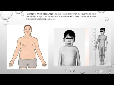 Синдром Клайнфельтера - хромосомная патология, обусловленная наличием в мужском кариотипе одной или