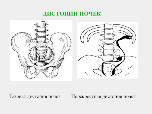 ДИСТОПИИ ПОЧЕК Тазовая дистопия почек Перекрестная дистопия почек