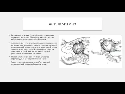 АСИНКЛИТИЗМ Вставление головки (synclitismus) – отношение стреловидного шва к симфизу и мысу