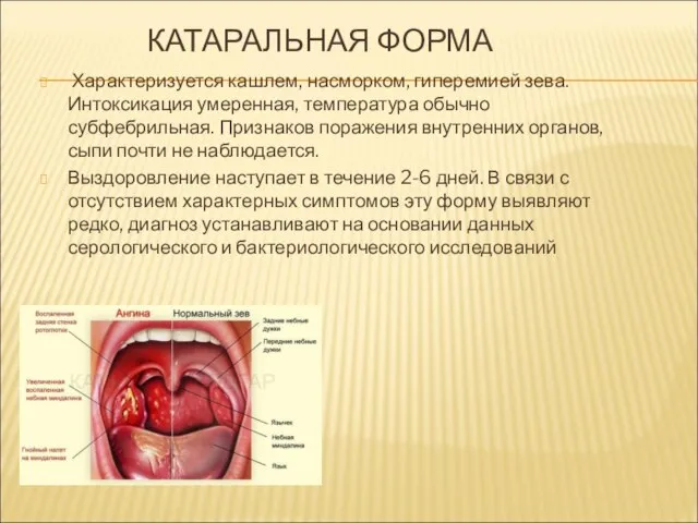 КАТАРАЛЬНАЯ ФОРМА Характеризуется кашлем, насморком, гиперемией зева. Интоксикация умеренная, температура обычно субфебрильная.