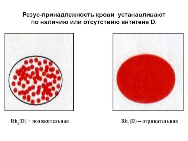 Резус-принадлежность крови устанавливают по наличию или отсутствию антигена D. Rh0(D) + положительная Rh0(D) – отрицательная