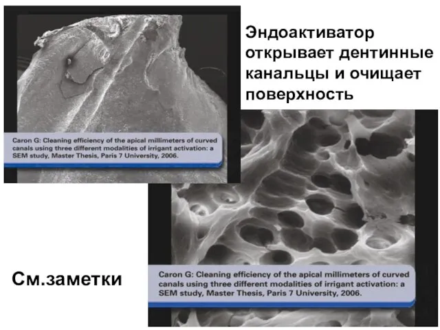 Эндоактиватор открывает дентинные канальцы и очищает поверхность См.заметки