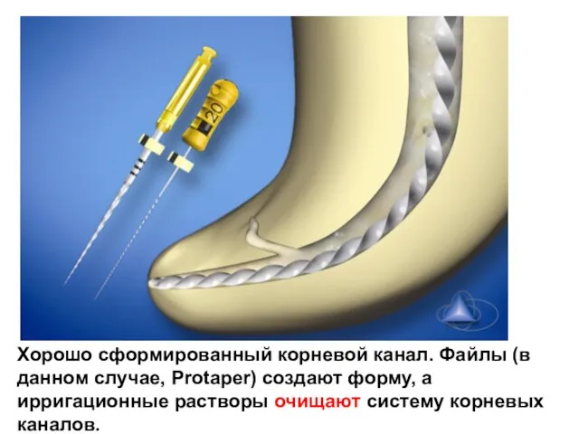 Хорошо сформированный корневой канал. Файлы (в данном случае, Protaper) создают форму, а