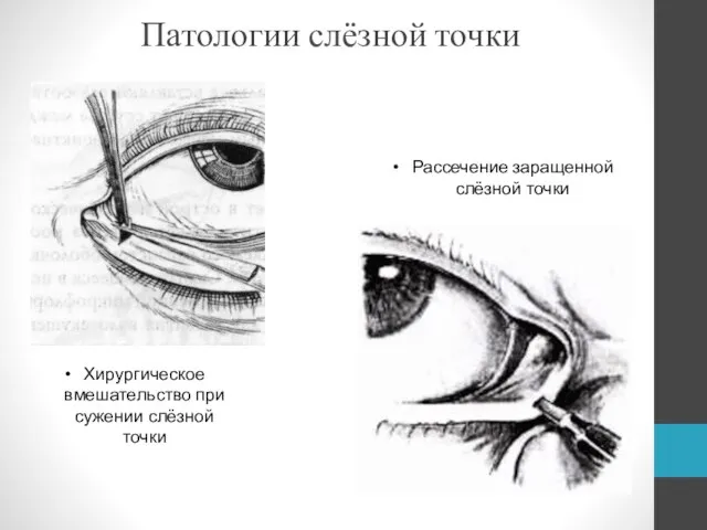 Патологии слёзной точки Рассечение заращенной слёзной точки Хирургическое вмешательство при сужении слёзной точки