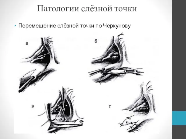 Патологии слёзной точки Перемещение слёзной точки по Черкунову