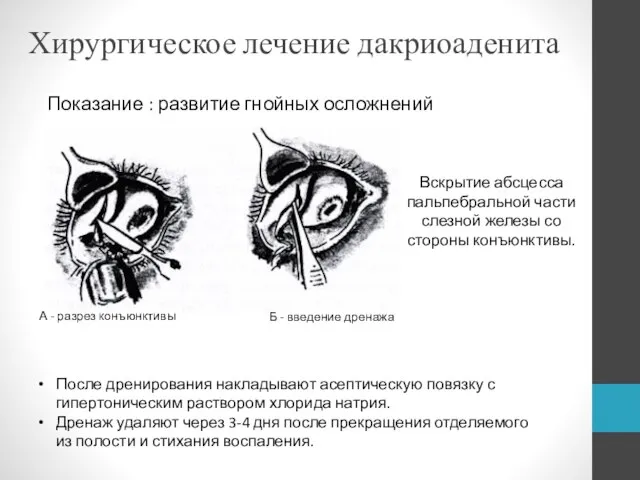 Хирургическое лечение дакриоаденита Показание : развитие гнойных осложнений Вскрытие абсцесса пальпебральной части