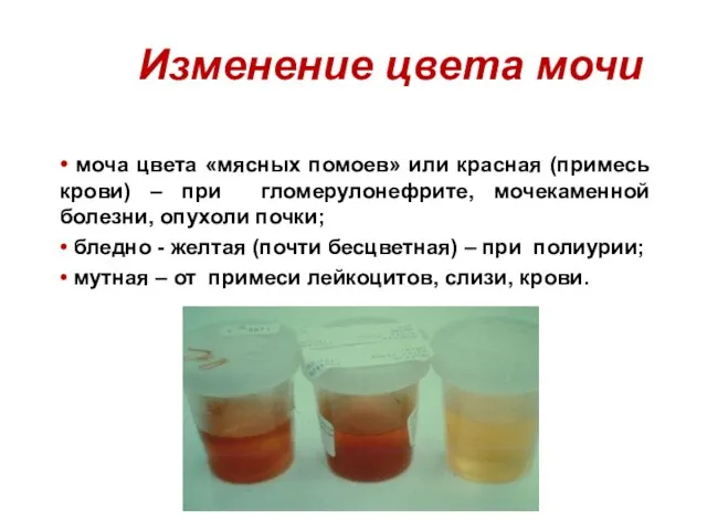 Изменение цвета мочи • моча цвета «мясных помоев» или красная (примесь крови)