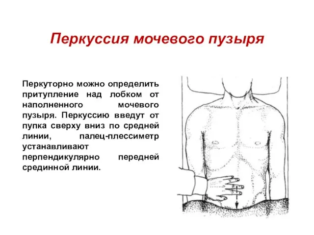 Перкуссия мочевого пузыря Перкуторно можно определить притупление над лобком от наполненного мочевого