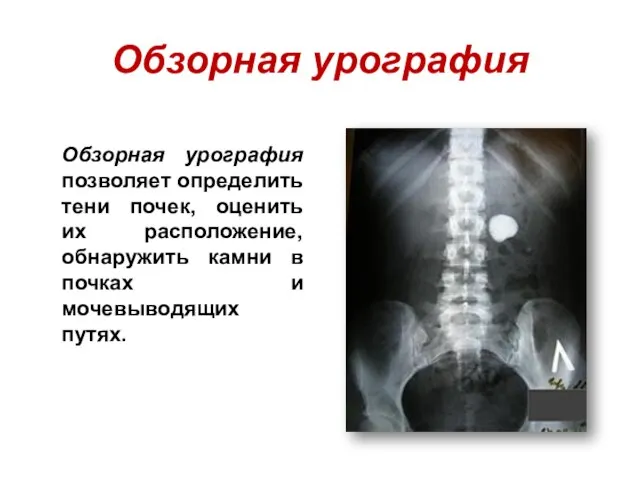 Обзорная урография Обзорная урография позволяет определить тени почек, оценить их расположение, обнаружить