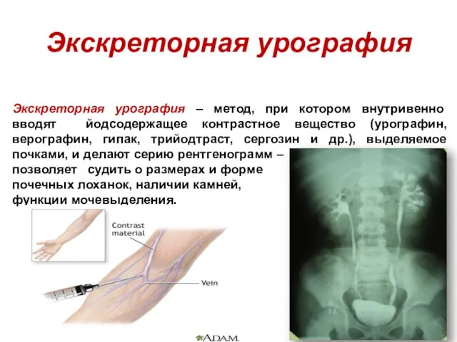 Экскреторная урография Экскреторная урография – метод, при котором внутривенно вводят йодсодержащее контрастное