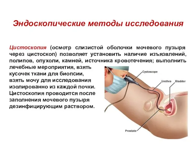 Эндоскопические методы исследования Цистоскопия (осмотр слизистой оболочки мочевого пузыря через цистоскоп) позволяет