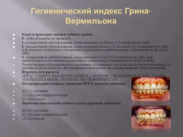 Гигиенический индекс Грина-Вермильона Коды и критерии оценки зубного камня: 0 - зубной