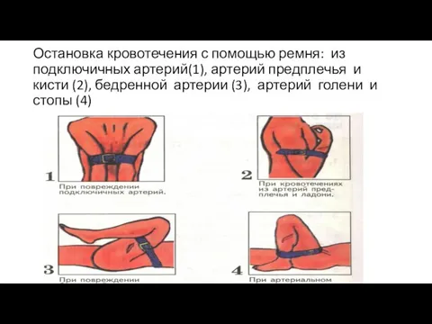 Остановка кровотечения с помощью ремня: из подключичных артерий(1), артерий предплечья и кисти